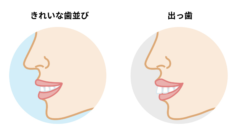 きれいな歯並びと出っ歯 - 熊本市矯正歯科相談室