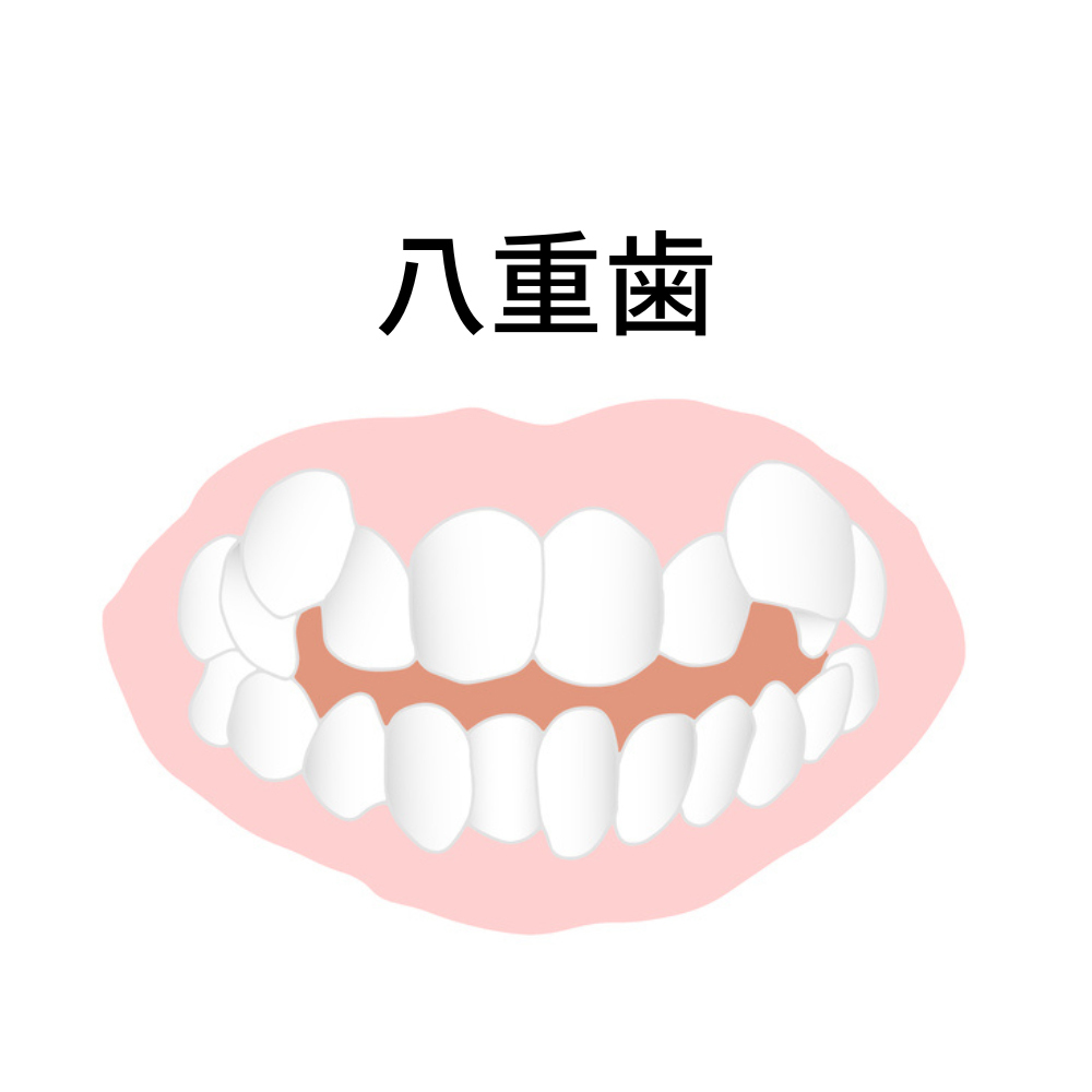 八重歯- 熊本市矯正歯科相談室