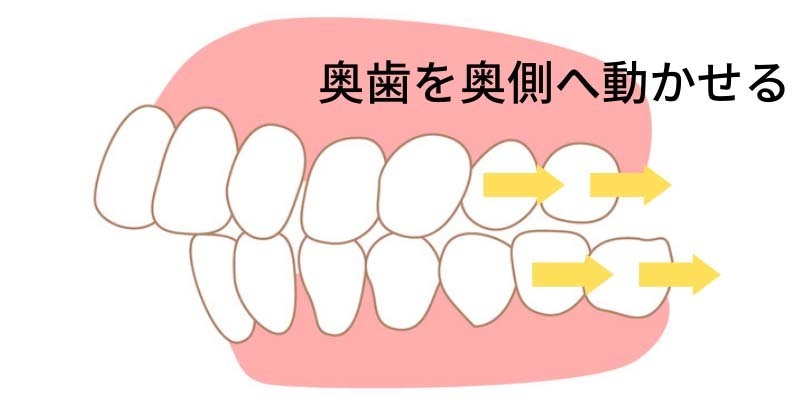 奥歯を奥側へ動かす- 熊本市矯正歯科相談室