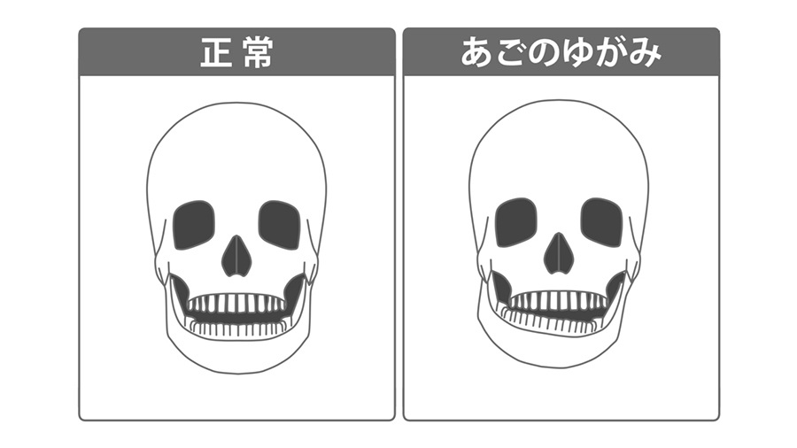 悪い噛み合わせは、目や口も歪ませる - 熊本市矯正歯科相談室