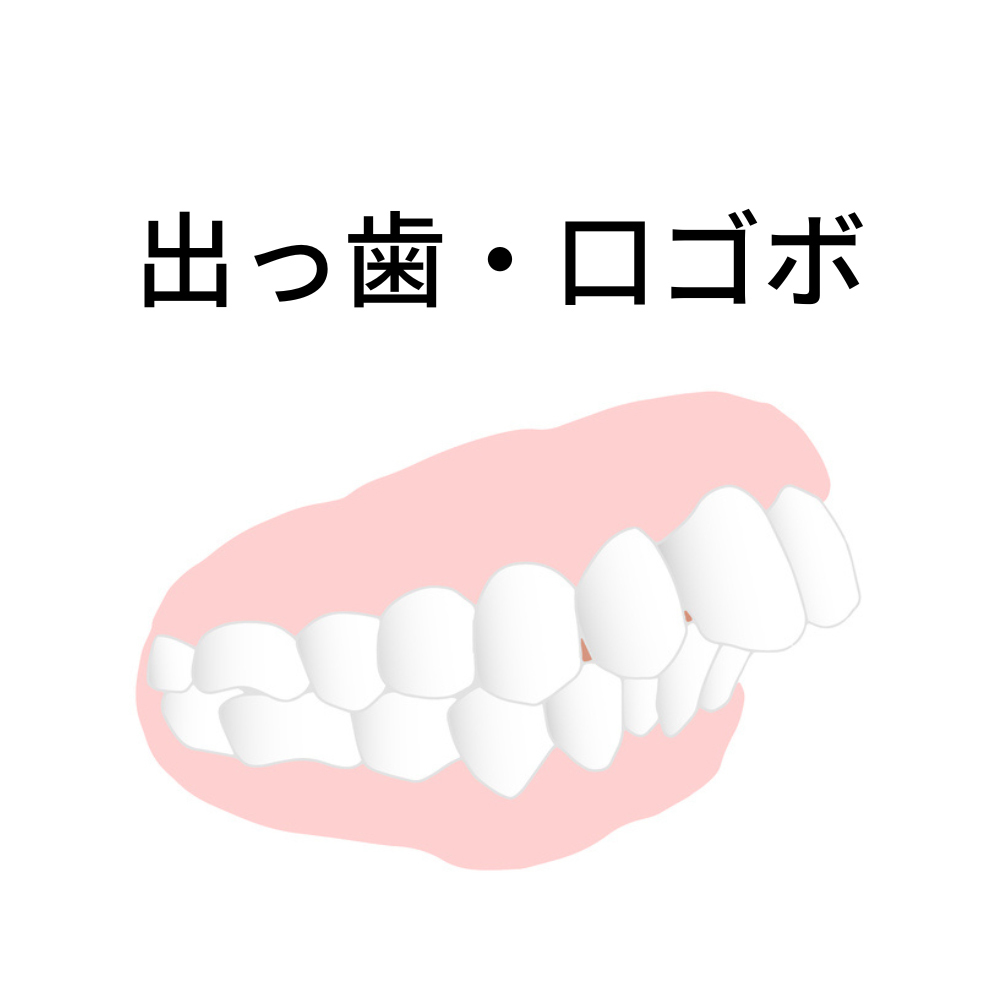 出っ歯・口ゴボ- 熊本市矯正歯科相談室